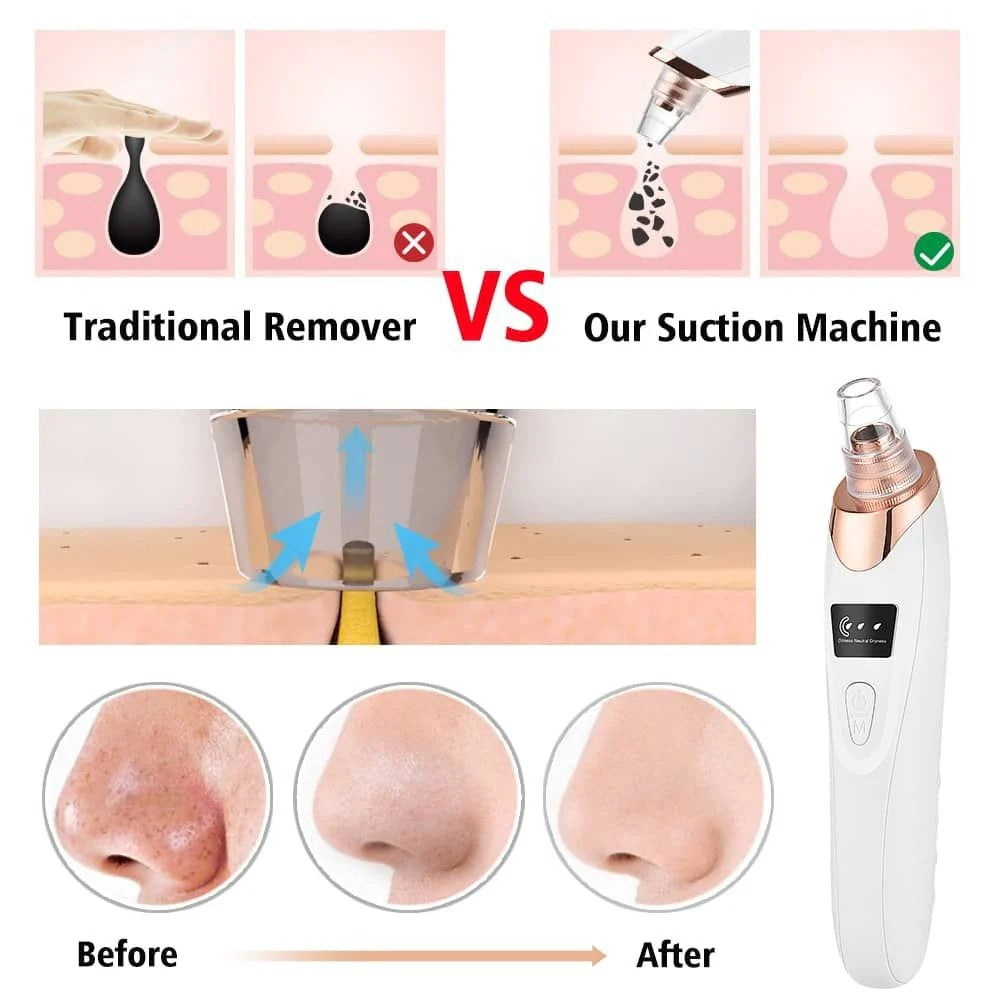 Electric Blackhead Remover Vacuum & Pore Cleaner Acne Suction Device, Deep Cleansing Tool with 5 Heads for Blackhead Removal & Smooth Skin Care